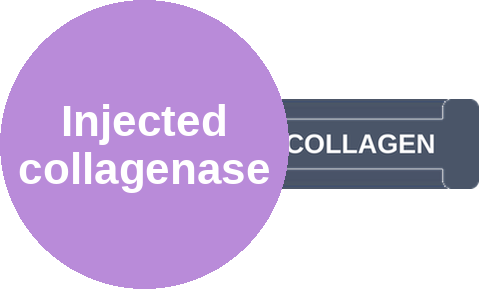 Injected collagenase — mechanism peg (Ballicules)